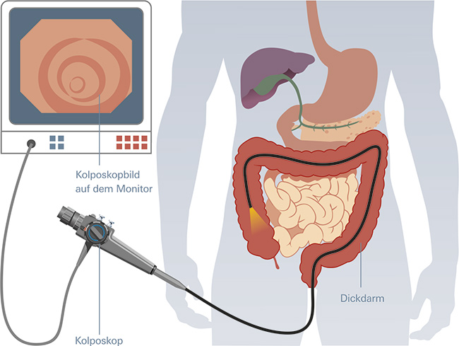 Schematische Darstellung einer Darmspiegelung. Im Darm befindet sich das Endoskop. 
	An dessen Anfang das Kolposkop sitzt, dass vom Arzt bedient wird. Das Videobild wird auch zu einem Monitor übertragen.